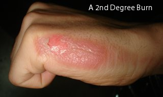 Illustration for article titled Scientists created a pain measurement scale by burning the hands of women in labor